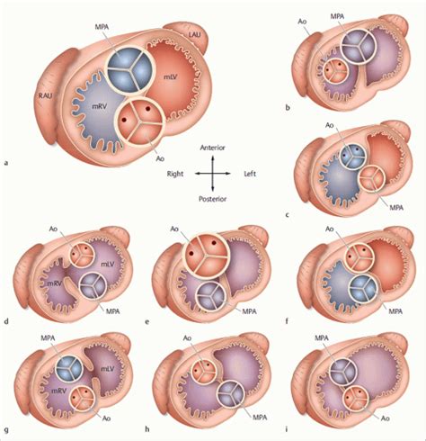 Cardiogenesis And Classification Of Congenital Heart Defects