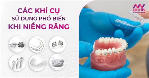 Các khí cụ niềng răng phổ biến trong quá trình chỉnh nha Nha Khoa My