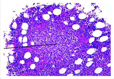 Hematoxylin And Eosin Stain Of Bone Marrow Aspirate Showing A Granuloma