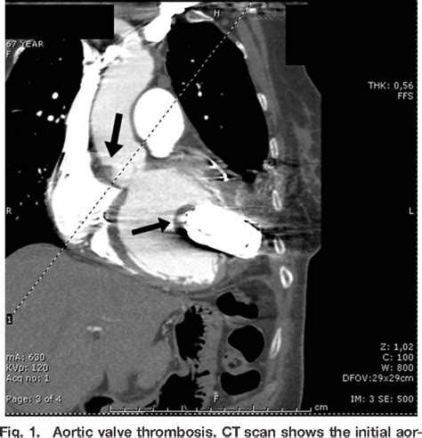 Figure 1 From VALVULAR AND STRUCTURAL HEART DISEASES Case Reports Novel