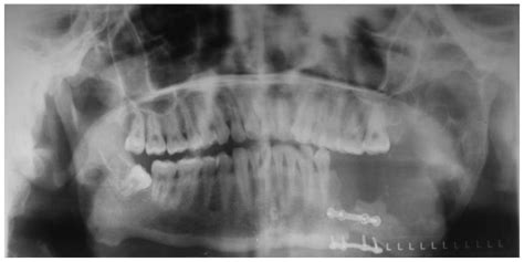 Panoramic Radiograph Showing An Extensive Ill Defined Multilocular