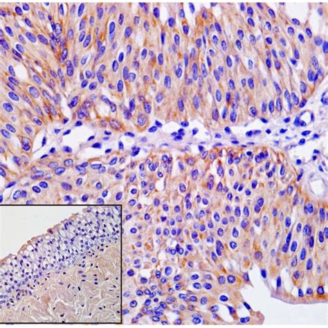 Urothelial Carcinoma Immunohistochemical Detection Of Phosphorylated