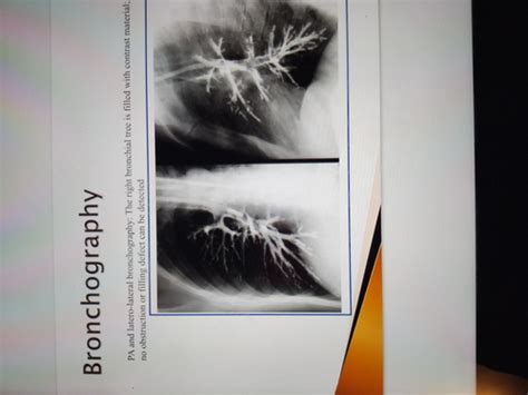 Chest X Ray Flashcards Quizlet