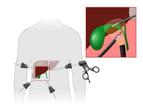 Laparoscopic Cholecystectomy