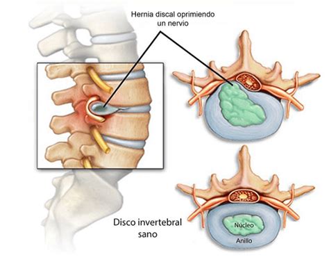 Claves Para Prevenir Las Hernias Discales Atacama Noticias Hot Sex