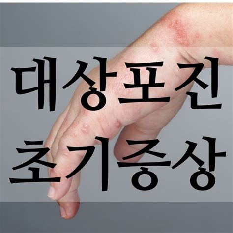 대상포진 초기증상 원인 치료 방법 대상포진의 모든 것