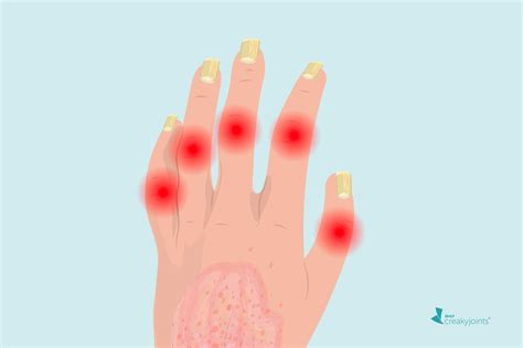 People with Nail Psoriasis May Have a Higher Chance of Developing PsA