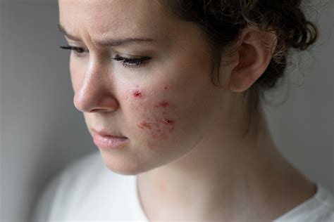 Skins Lipid Cells Could Become Your New Ally Against Acne Science Says So