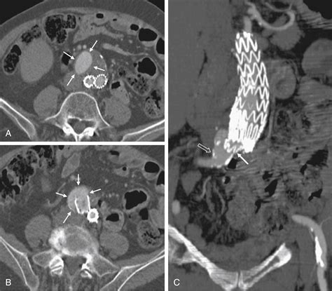 Endoleaks Classification Diagnosis And Treatment Clinical Tree