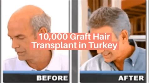 Graft Hair Transplant In Turkey Grafts Hair Transplant