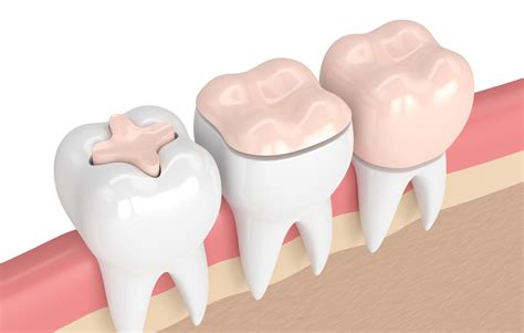 Dental Inlays And Onlays Aurora Cavity Fillings Tooth Restoration