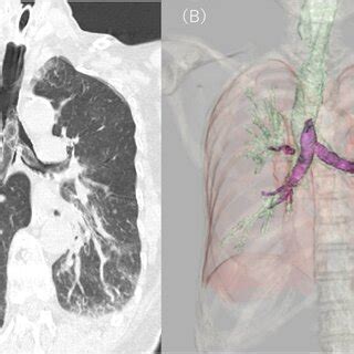 Chest Ct Findings A Plain Ct Coronal Section B Three Dimensional