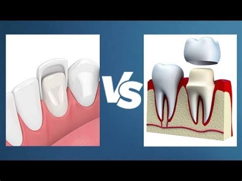 Difference Between Crown And Veneer | Renew Physical Therapy