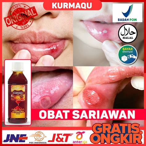 Jual Obat Sariawan Obat Mulut Sariawan Obat Bibir Pecah Pecah