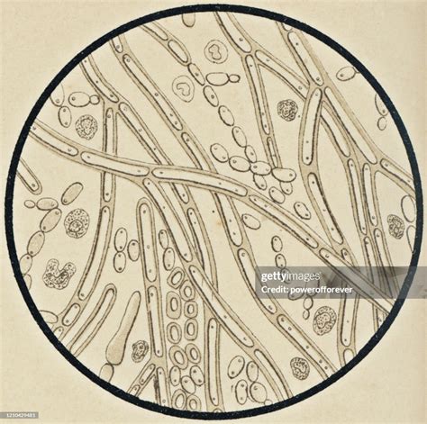 Vue Microscopique De Candida Albicans Dun Patient Avec Mycosis 19ème