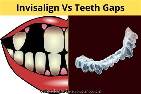 Can Invisalign Fix Gaps From Missing Teeth Orthodontic Braces Care