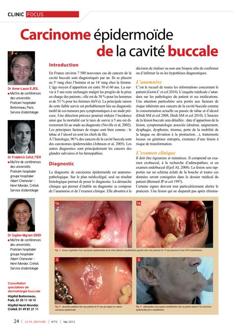 PDF Carcinome épidermoïde de la cavité buccale