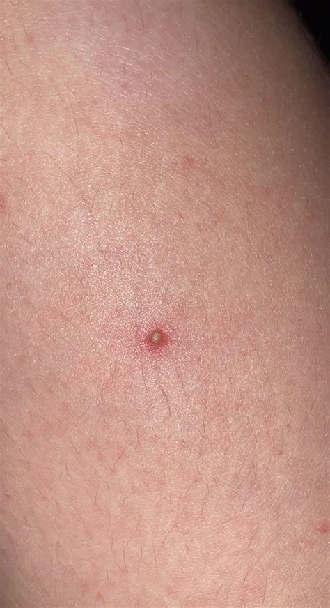 Does this look like MRSA, randomly sprouted on my leg : r/MRSA