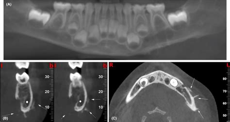 Cbct Reformatted Images A Multiplanar Reformatted Panoramic Image