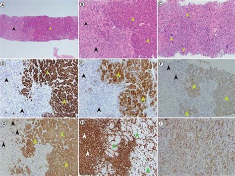 Full Article A Rare Histologic Subtype Of Hepatocellular Carcinoma