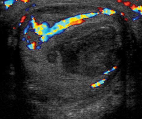 Testicular Tumors What Radiologists Need To Know—differential