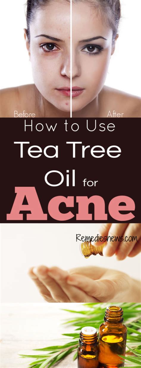 How to Use Tea Tree Oil for Acne : 11 Powerful Tea Tree Oil Recipes