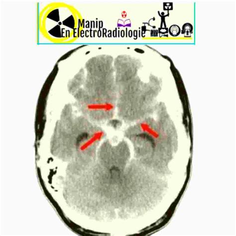 Tdm Cerebrale Scannr Cerebral