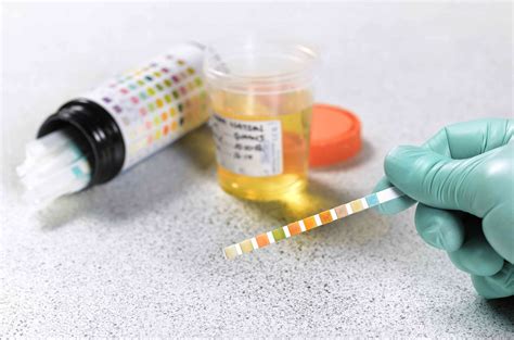 Glycosuria: Symptoms, Causes, Diagnosis, and Treatment