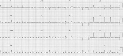 Atrial Flutter • Litfl • Ecg Library Diagnosis