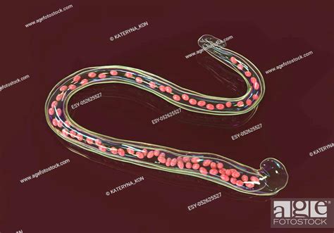 Wuchereria Bancrofti A Roundworm Nematode One Of The Causative Agents Of Lymphatic Filariasis