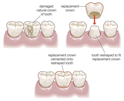 DENTAL CROWNS – Healthy Smiles of Abington