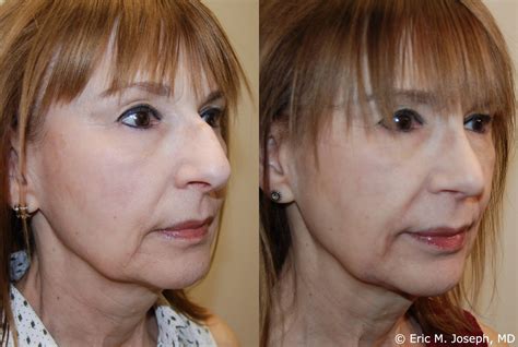 Eric M Joseph Md Rhinoplasty Before And After Hanging Columella And