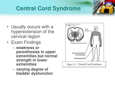 Ppt Spinal Cord Injury Powerpoint Presentation Free Download Id