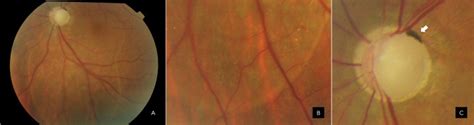 Serous Macular Detachment Associated With Optic Nerve Head Cupping In