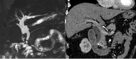 Frontiers Mrcp Combined With Ct Promotes The Differentiation Of Benign And Malignant Distal