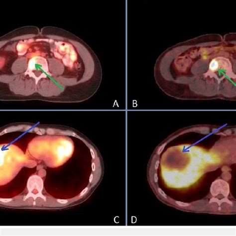 68 Ga DOTATATE PET CT Results A Anterior MIP B Coronal Fusion In A