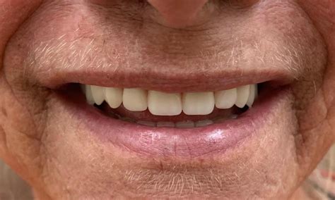 Royal Palm Beach Dentist Dentures Before And After