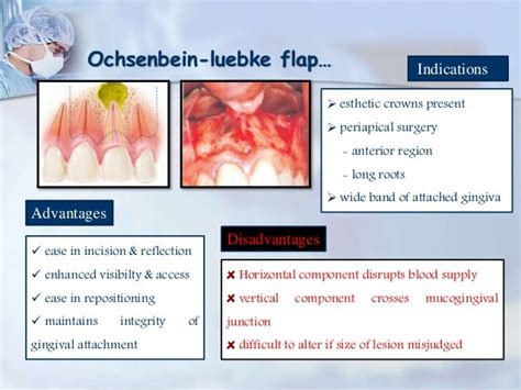 Endodontic Surgery