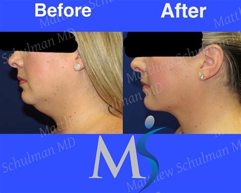 Best Chin Liposuction In New York Cost And Photos Matthew Schulman