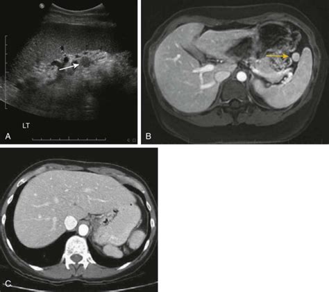 Benign And Malignant Lesions Of The Spleen Radiology Key