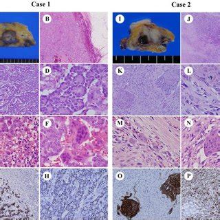 Gross And Microscopic Findings Of Breast Carcinoma With Ogcs Ogcs In