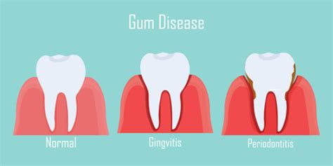 How To Recognize The Early Signs Of Gingivitis And Periodontitis Now