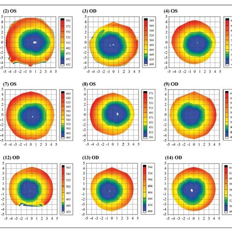 Stromal Thickness Maps Of 15 Randomly Selected Eyes Each Plotted With