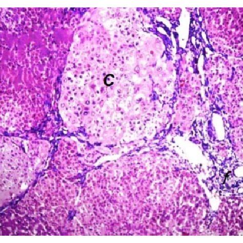 Photomicrograph Of Liver Tissue Section Of Untreated Hcc Bearing Rat