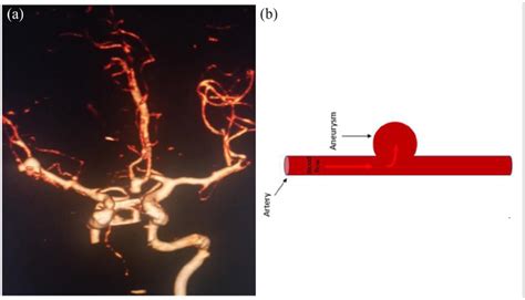 (a) Multiple saccular aneurysm. (b) Saccular aneurysm. | Download Scientific Diagram