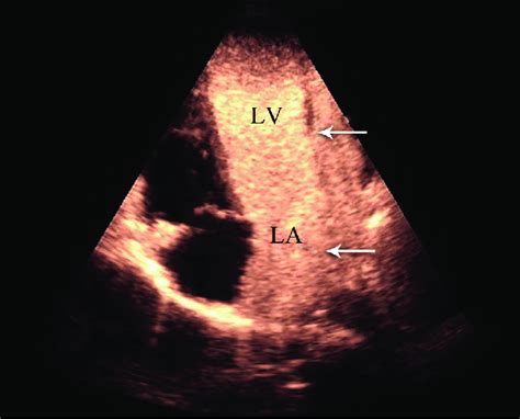 Transthoracic Echocardiography In The Apical 4 Chamber View With