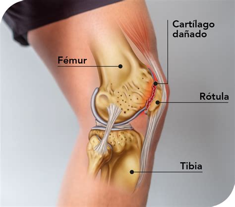 Condromalacia Rotuliana qué es causas y tratamiento Clínica DKF