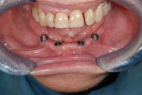 Full Arch Implant Bridges Demajo Dental