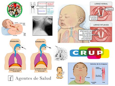 Agentes De Salud Laringotraqueitis Obstructiva Aguda CRUP