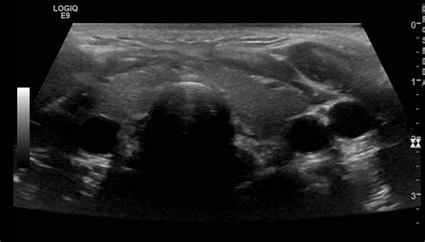 Thyroid Ultrasound Cpt 2024 Alia Louise